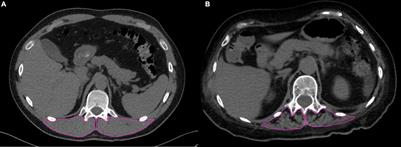 Myosteatosis Significantly Predicts Persistent Dyspnea and Mobility Problems in COVID-19 Survivors